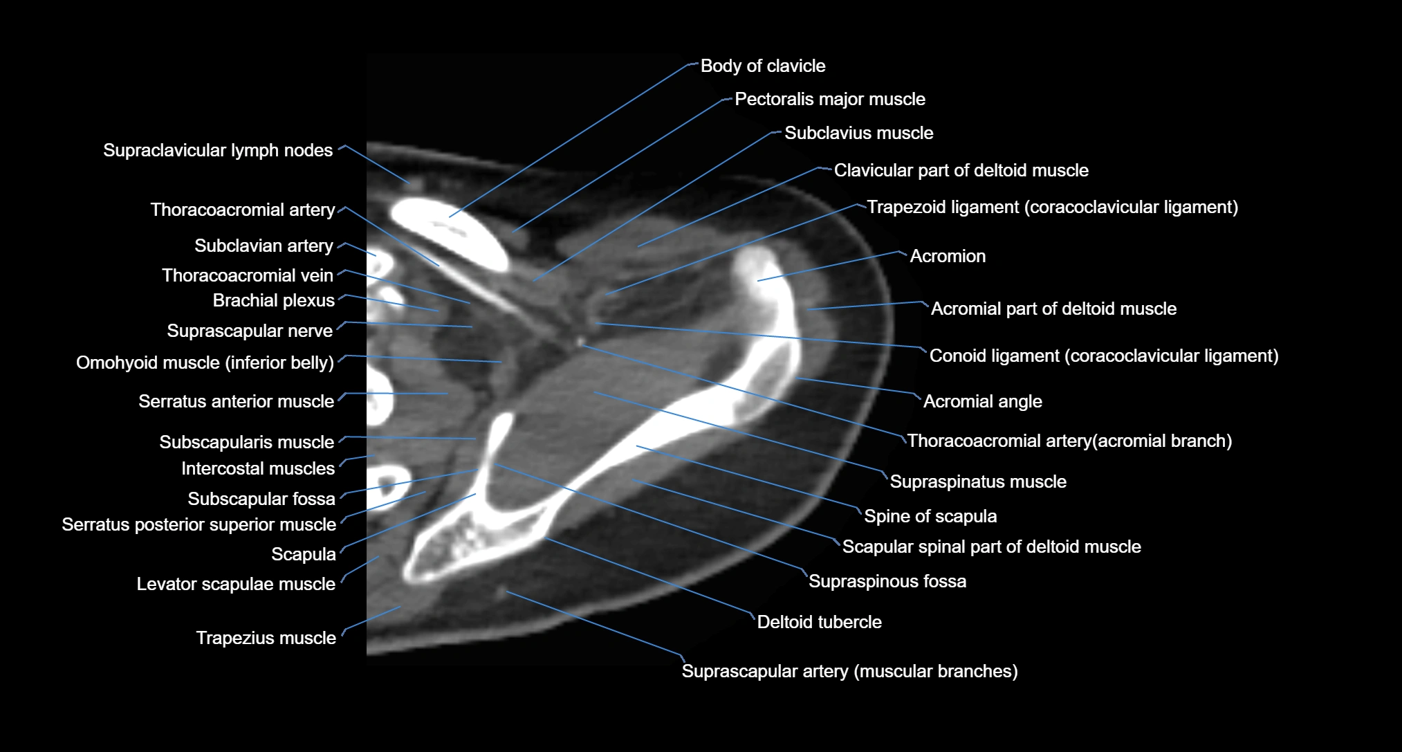 CT Shoulder axial cross sectional anatomy labelled radiology image -00019.webp